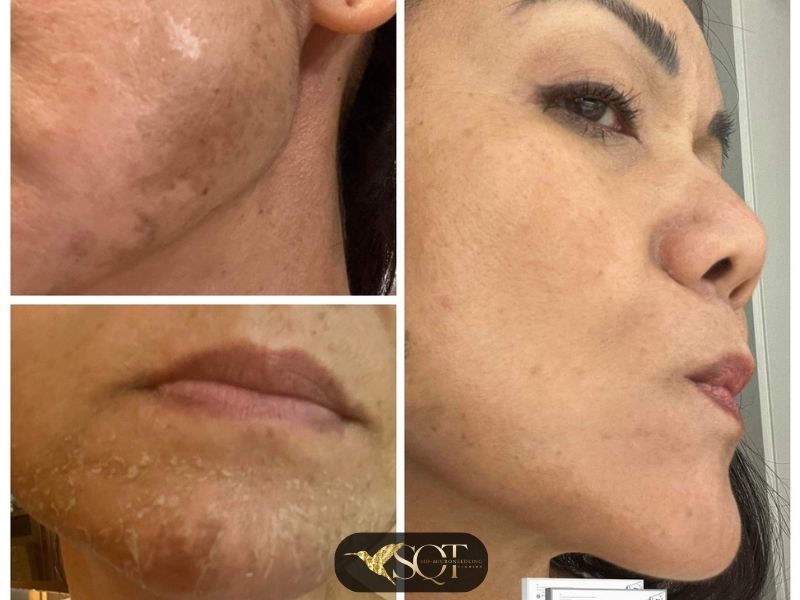sqt-bio-microneedling-4.jpg