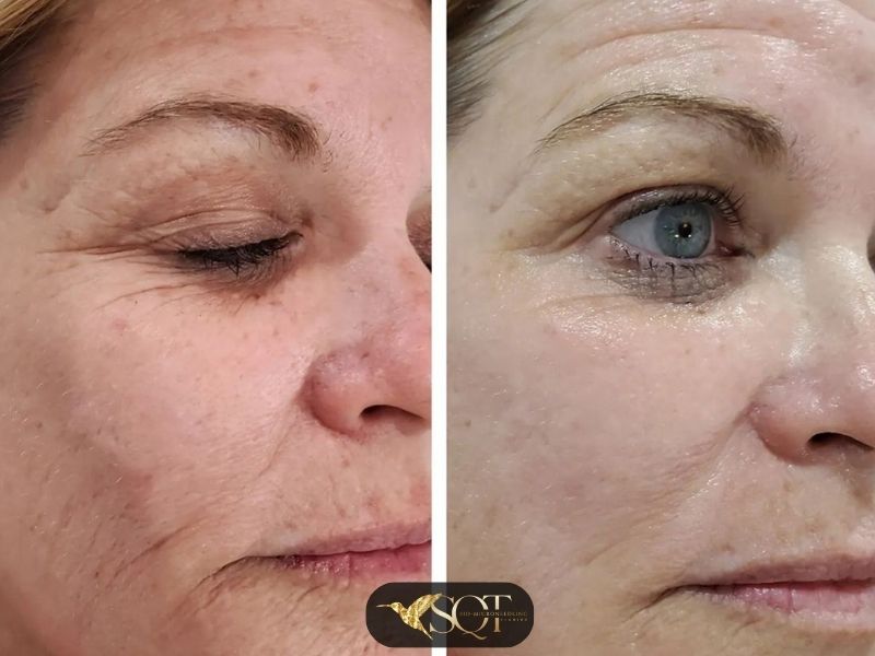sqt-bio-microneedling-5.jpg